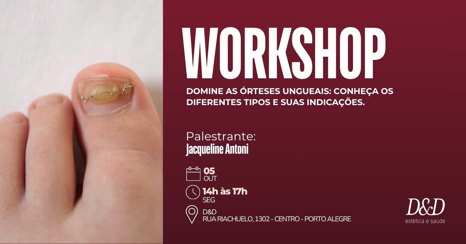 Workshop - Domine as Órteses Ungueais: Conheça os Diferentes Tipos e Suas Indicações